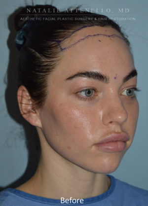 Hairline Lowering/Forehead Reduction Case 4496 Before Photo Hairline Lowering/Forehead Reduction