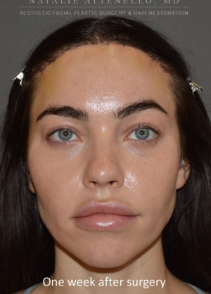 Hairline Lowering/Forehead Reduction Case 4496 After Photo Hairline Lowering/Forehead Reduction