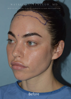 Hairline Lowering/Forehead Reduction Case 4496 Before Photo Hairline Lowering/Forehead Reduction