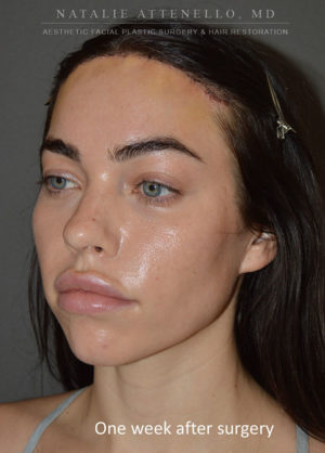 Hairline Lowering/Forehead Reduction Case 4496 After Photo Hairline Lowering/Forehead Reduction