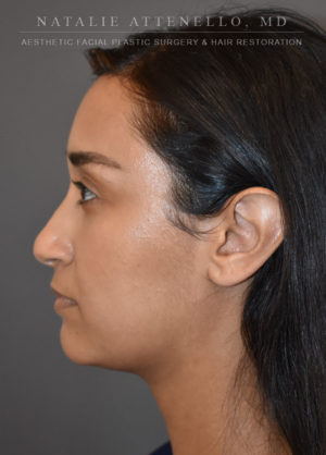 Hairline Lowering/Forehead Reduction Case 4497 After Photo Hairline Lowering/Forehead Reduction