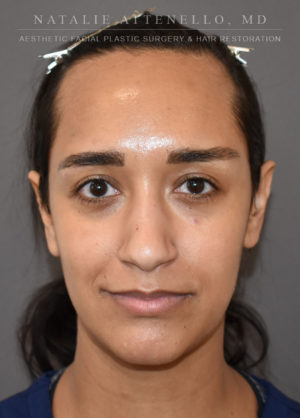 Hairline Lowering/Forehead Reduction Case 4497 Before Photo Hairline Lowering/Forehead Reduction
