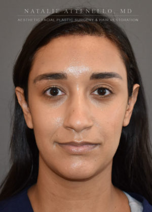 Hairline Lowering/Forehead Reduction Case 4497 After Photo Hairline Lowering/Forehead Reduction