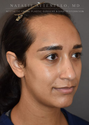 Hairline Lowering/Forehead Reduction Case 4497 Before Photo Hairline Lowering/Forehead Reduction