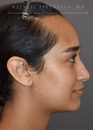 Hairline Lowering/Forehead Reduction Case 4497 Before Photo Hairline Lowering/Forehead Reduction