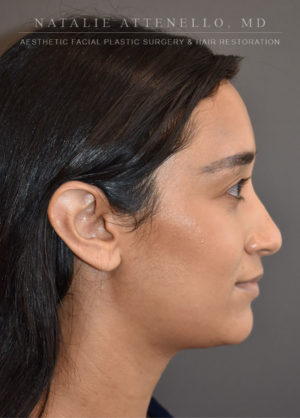Hairline Lowering/Forehead Reduction Case 4497 After Photo Hairline Lowering/Forehead Reduction