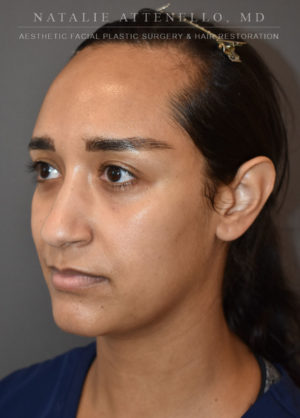 Hairline Lowering/Forehead Reduction Case 4497 Before Photo Hairline Lowering/Forehead Reduction