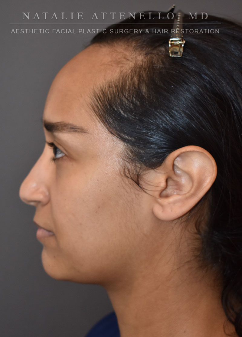 Hairline Lowering/Forehead Reduction