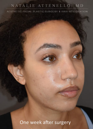 Hairline Lowering/Forehead Reduction Case 4499 After Photo Hairline Lowering/Forehead Reduction