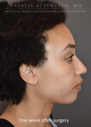 Hairline Lowering/Forehead Reduction Case 4499 After Photo Hairline Lowering/Forehead Reduction