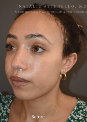 Hairline Lowering/Forehead Reduction Case 4499 Before Photo Hairline Lowering/Forehead Reduction