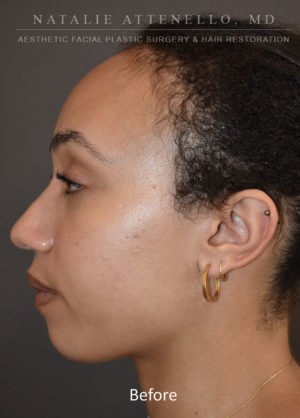 Hairline Lowering/Forehead Reduction Case 4499 Before Photo Hairline Lowering/Forehead Reduction