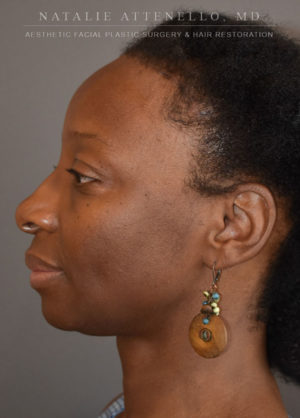 Hairline Lowering/Forehead Reduction Case 4501 After Photo Hairline Lowering/Forehead Reduction