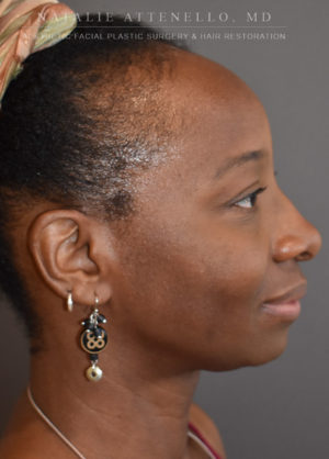 Hairline Lowering/Forehead Reduction Case 4501 Before Photo Hairline Lowering/Forehead Reduction