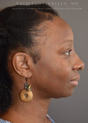 Hairline Lowering/Forehead Reduction Case 4501 After Photo Hairline Lowering/Forehead Reduction
