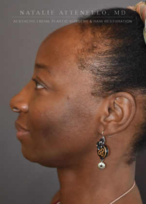 Hairline Lowering/Forehead Reduction Case 4501 Before Photo Hairline Lowering/Forehead Reduction