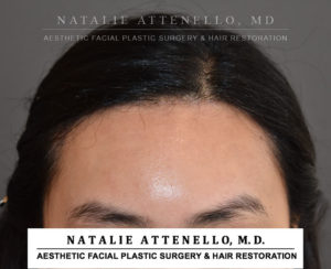 Hairline Lowering/Forehead Reduction