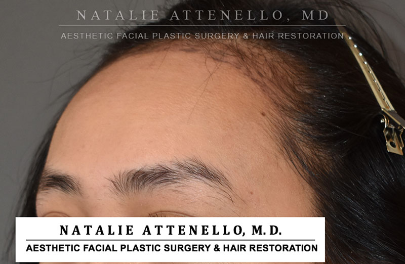 Hairline Lowering/Forehead Reduction