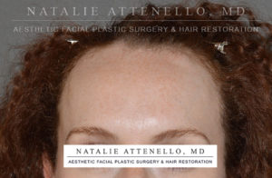 Hairline Lowering/Forehead Reduction Case 4504 Before Photo Hairline Lowering/Forehead Reduction