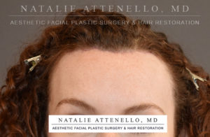 Hairline Lowering/Forehead Reduction Case 4504 After Photo Hairline Lowering/Forehead Reduction