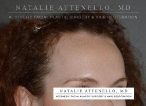 Hairline Lowering/Forehead Reduction Case 4504 Before Photo Hairline Lowering/Forehead Reduction