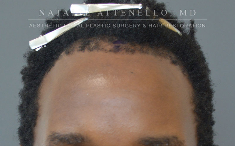 Hairline Lowering/Forehead Reduction