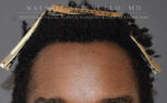 Hairline Lowering/Forehead Reduction