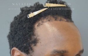 Hairline Lowering/Forehead Reduction