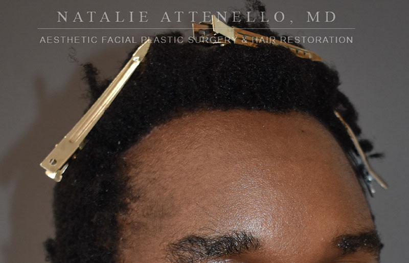 Hairline Lowering/Forehead Reduction