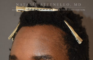 Hairline Lowering/Forehead Reduction