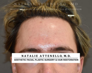 Hairline Lowering/Forehead Reduction Case 4506 Before Photo Hairline Lowering/Forehead Reduction