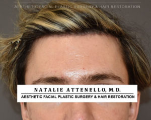 Hairline Lowering/Forehead Reduction Case 4506 After Photo Hairline Lowering/Forehead Reduction