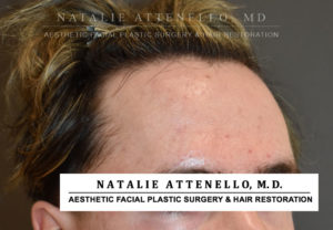 Hairline Lowering/Forehead Reduction Case 4506 Before Photo Hairline Lowering/Forehead Reduction