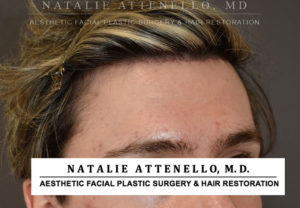 Hairline Lowering/Forehead Reduction Case 4506 After Photo Hairline Lowering/Forehead Reduction