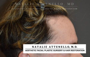 Hairline Lowering/Forehead Reduction Case 4506 Before Photo Hairline Lowering/Forehead Reduction