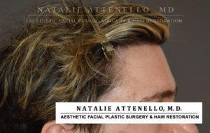Hairline Lowering/Forehead Reduction Case 4506 After Photo Hairline Lowering/Forehead Reduction