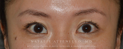 Blepharoplasty