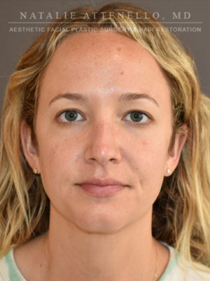 Blepharoplasty Case 4709 Before Photo Blepharoplasty