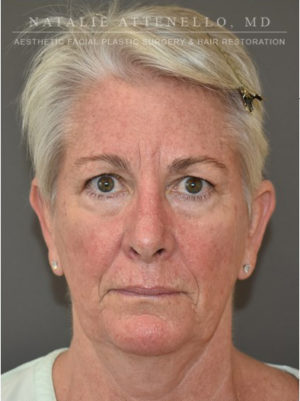 Blepharoplasty Case 4717 Before Photo Blepharoplasty