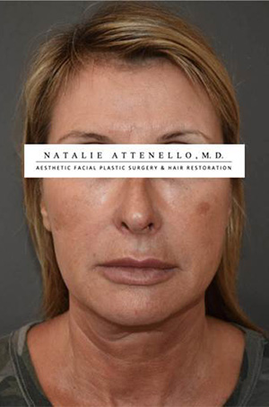 Facelift Case 4660 Before Photo Facelift