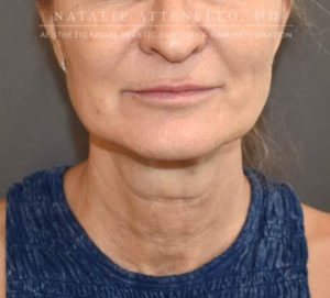 Facelift Case 4655 Before Photo Facelift