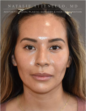 Hairline Lowering/Forehead Reduction Case 4734 Before Photo Hairline Lowering/Forehead Reduction