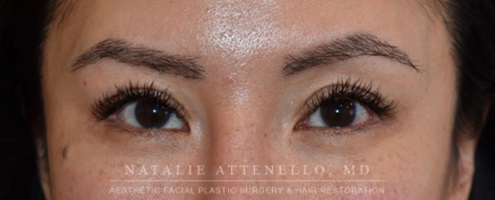 Blepharoplasty