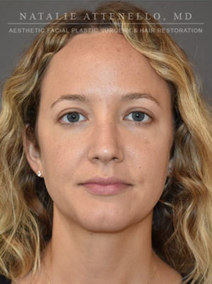 Blepharoplasty Case 4709 After Photo Blepharoplasty