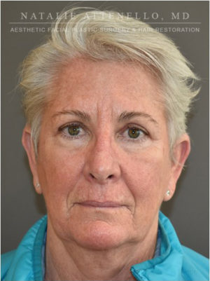 Blepharoplasty Case 4717 After Photo Blepharoplasty