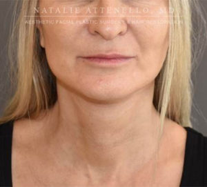 Facelift Case 4655 After Photo Facelift