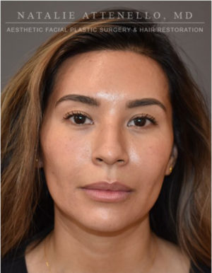 Hairline Lowering/Forehead Reduction Case 4734 After Photo Hairline Lowering/Forehead Reduction