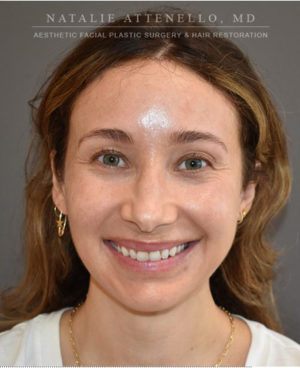 Hairline Lowering/Forehead Reduction Case 4741 After Photo Hairline Lowering/Forehead Reduction