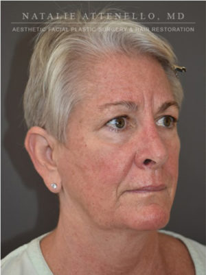 Blepharoplasty Case 4717 Before Photo Blepharoplasty
