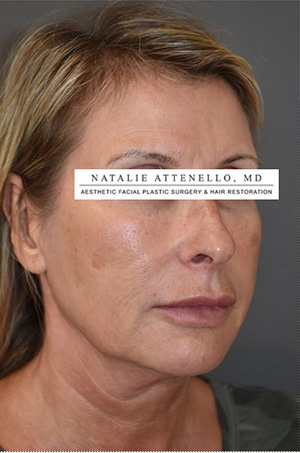Facelift Case 4660 Before Photo Facelift